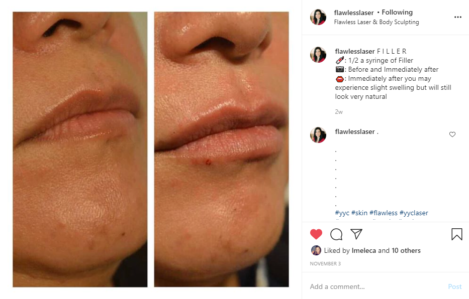 Flawless Laser Calgary Client Lip Fillers Before and After 2