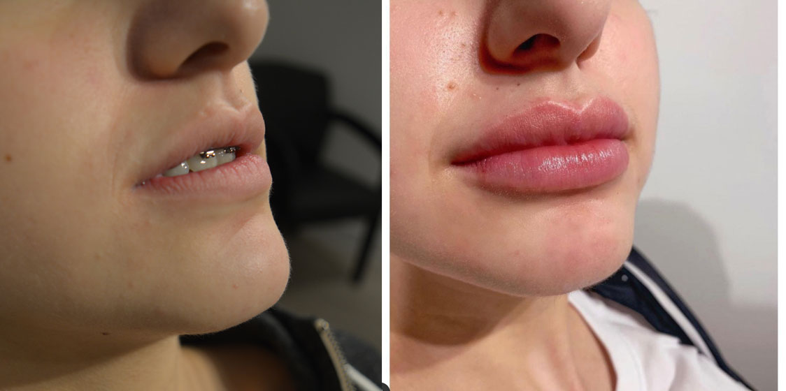 Flawless Laser Calgary Client Lip Fillers Before and After