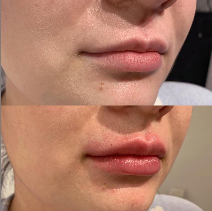 Calgary Lip Filler done right by our aesthetic registered nurse injector