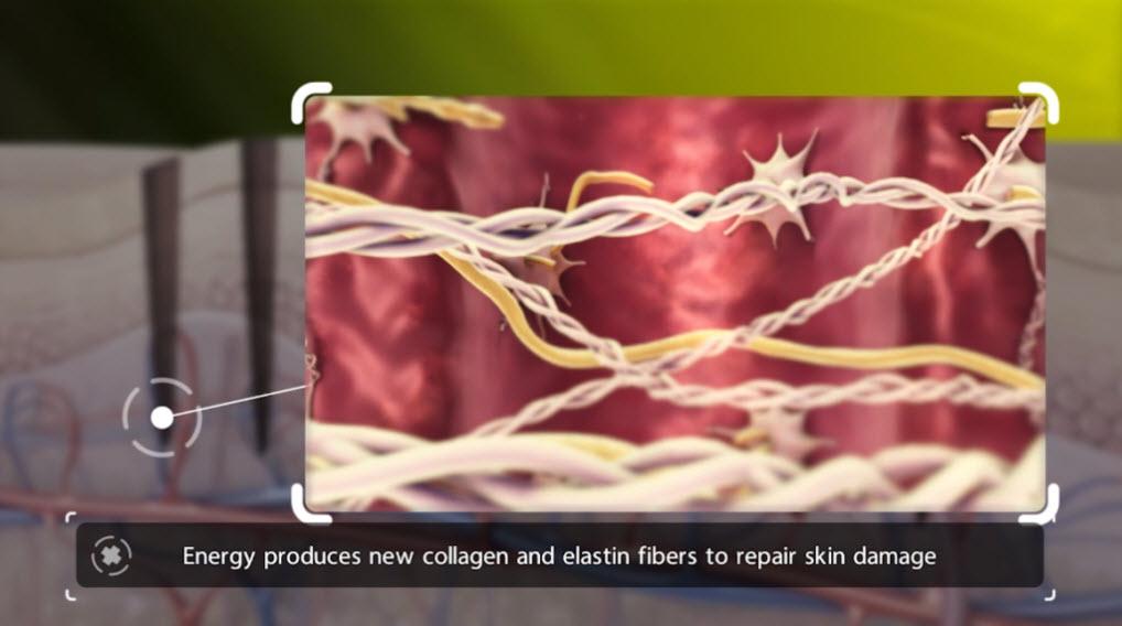 Venus Viva Calgary Laser Resurfacing - energy produces new collagen and elastin fibers to repair skin damage