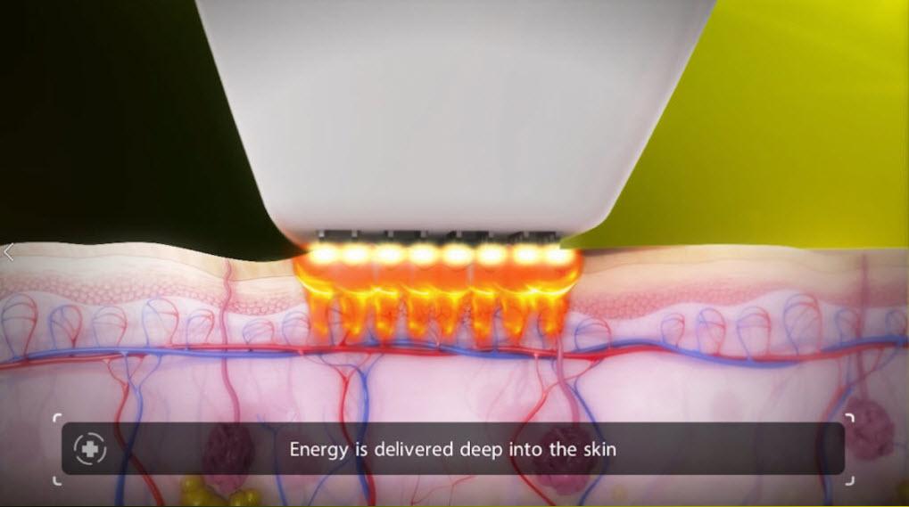 Venus Viva Calgary Laser Skin Resurfacing - energy is delivered deep into the skin