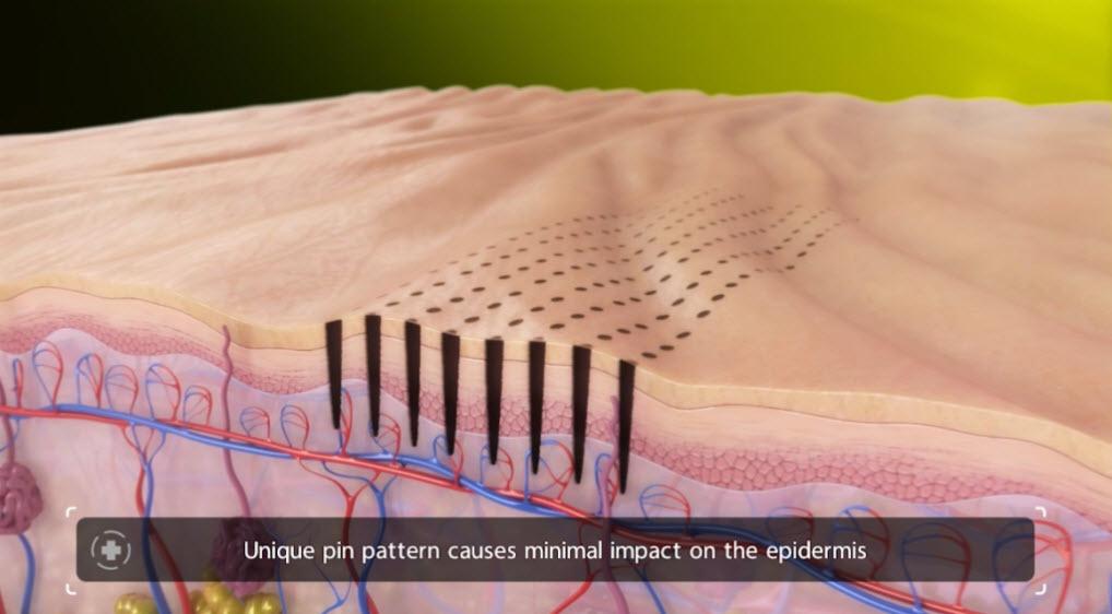 Venus Viva Calgary Skin Resurfacing - unique pin pattern causes minimal impact on the epidermis