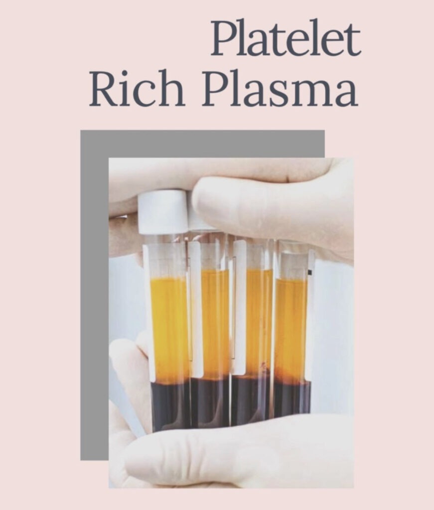Platelet Rich Plasma in Calgary