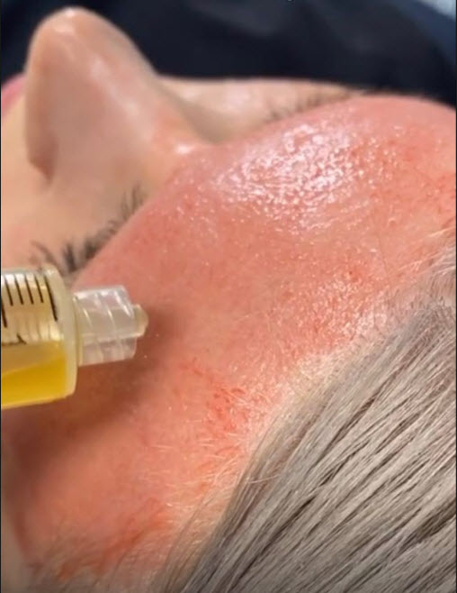 PRP injected into forehead