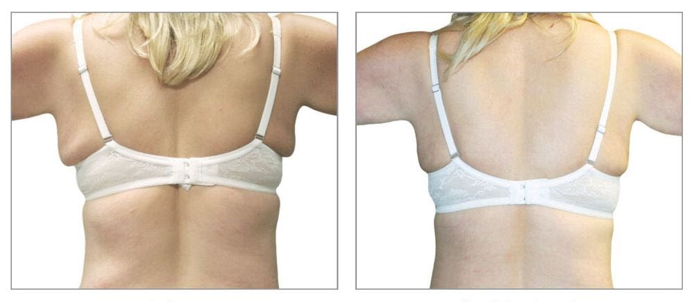 Venus Bliss Permanent Fat Reduction in Calgary back cropped