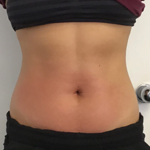 Venus Bliss Permanent Fat Reduction Belly Slimming After in Calgary