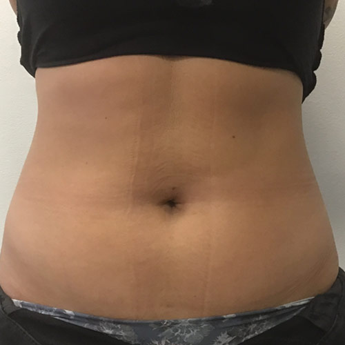 Venus Bliss Permanent Fat Reduction Belly Slimming Before in Calgary