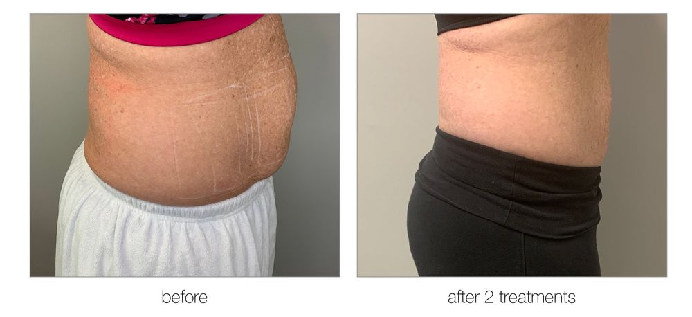 Venus Bliss Permanent Fat Reduction Body Slimming and Shaping Before and After Calgary Alberta Results