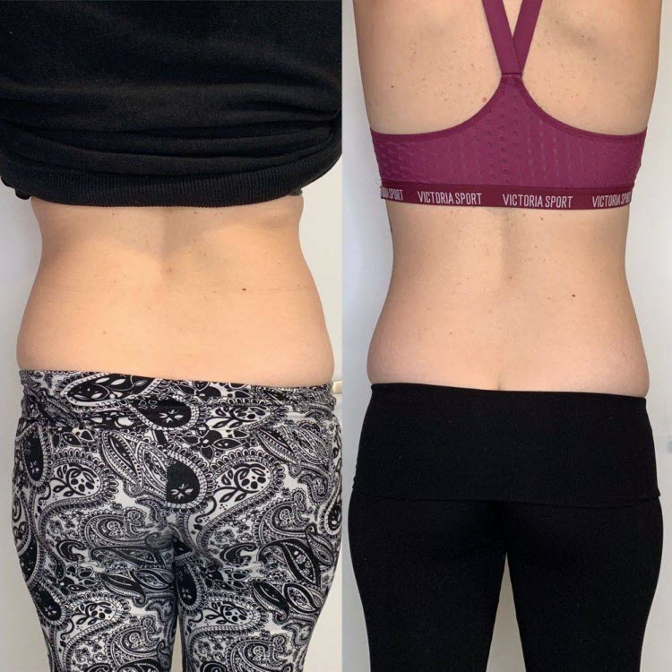 Venus Bliss Permanent Fat Reduction Body Slimming and Shaping Before and After
