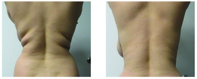 Venus Bliss Permanent Fat Reduction Back Before and After
