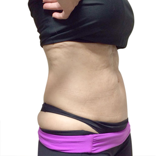 Venus Bliss Permanent Fat Reduction Stomach Before Picture