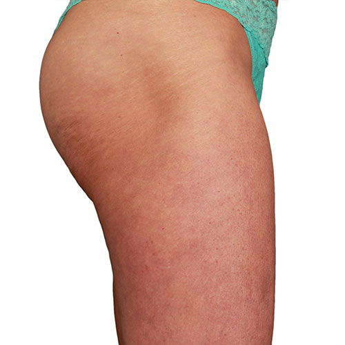 Venus Bliss Permanent Fat Reduction Legs  After in Calgary