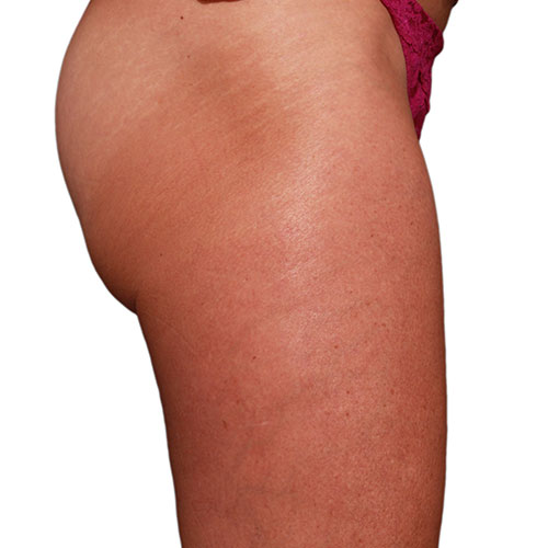 Venus Bliss Permanent Fat Reduction Legs Before and After in Calgary